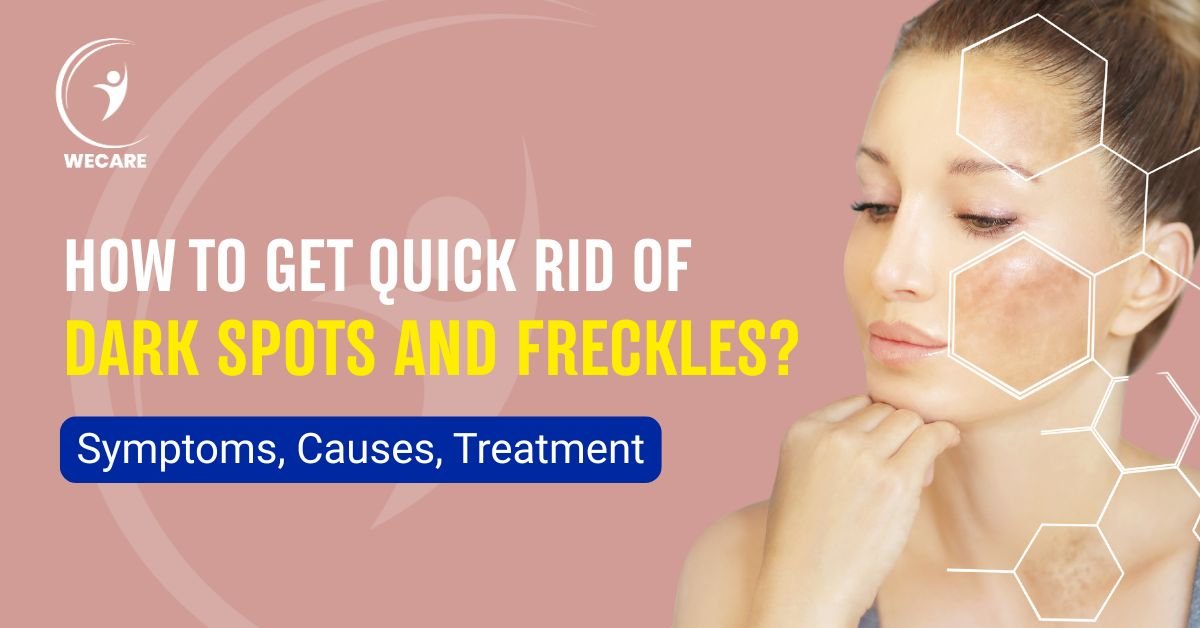 How to Get Quick Rid of Dark Spots and Freckles?